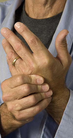 ¿Quién puede tener artritis reumatoide? ¿Quién puede tener artritis reumatoide?